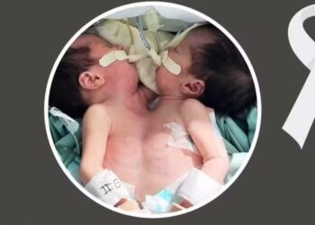 Gêmeas siamesas morrem uma semana após o nascimento