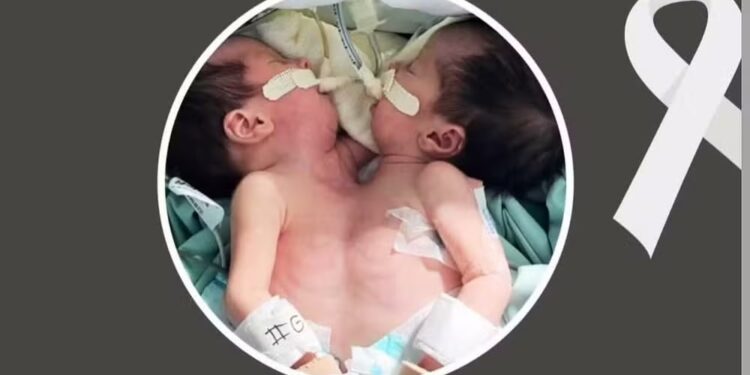 Gêmeas siamesas morrem uma semana após o nascimento