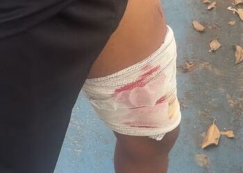 QUEIMOU: Homem é baleado enquanto dormia em residência na zona sul