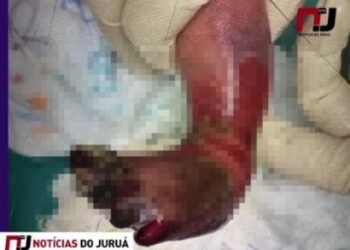 REVOLTANTE: recém-nascida sofre queimaduras de 3° grau durante banho em maternidade no Acre – Veja Vídeo