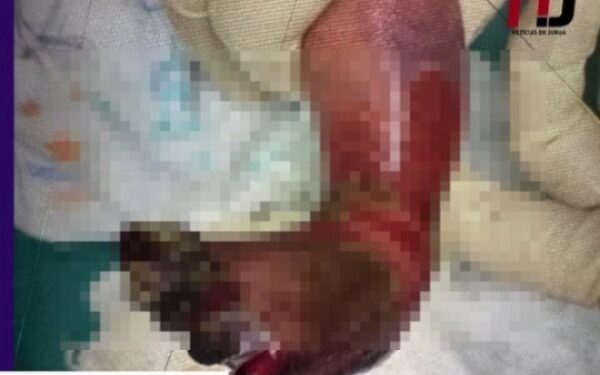 REVOLTANTE: recém-nascida sofre queimaduras de 3° grau durante banho em maternidade no Acre – Veja Vídeo