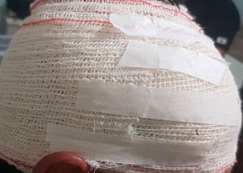 NO ESCURO: Homem é agredido com paulada e facão após ser confundido com ladrão de fios durante apagão